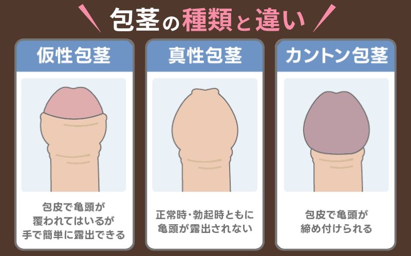 包茎 種類 違い