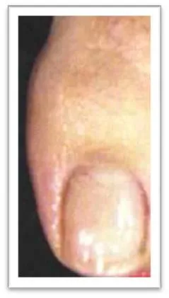 巻き爪治療~ブレイスクイック~