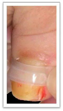 巻き爪治療~ブレイスクイック~